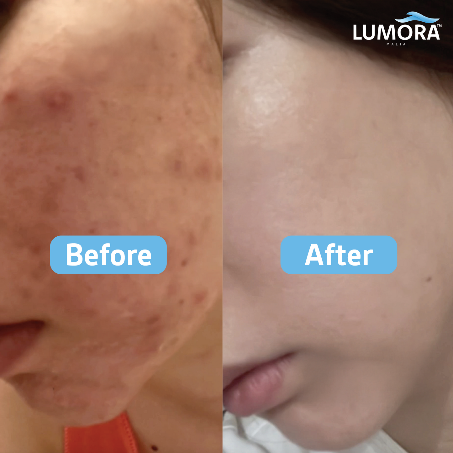 Lumora™ Faucet Filter
